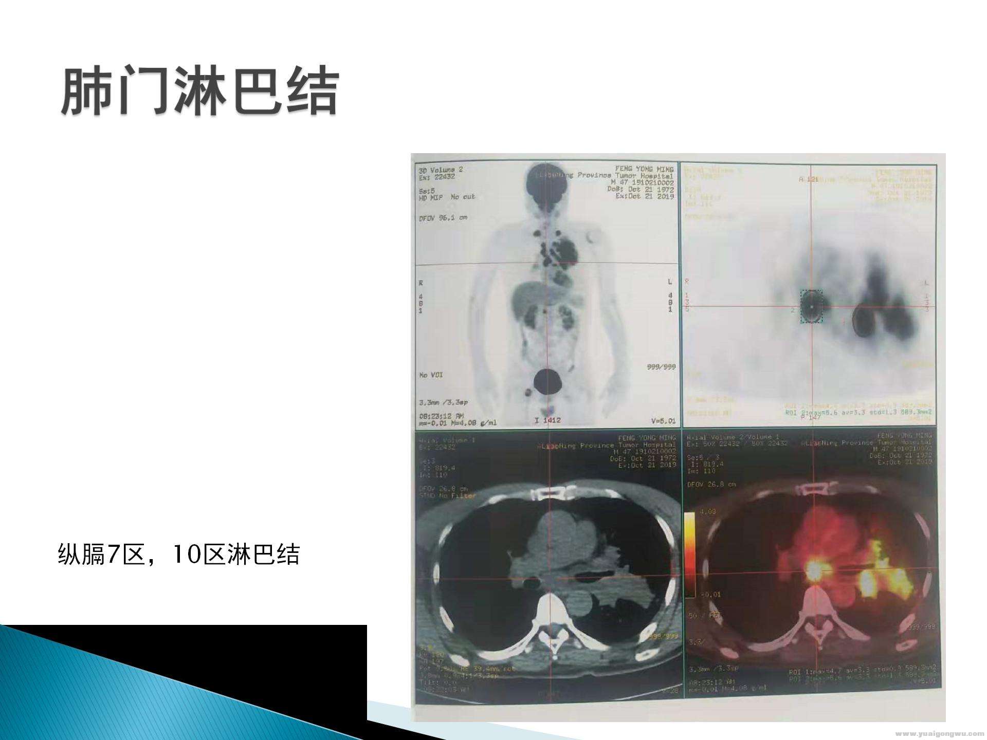 pd1病例讨论_09.jpg